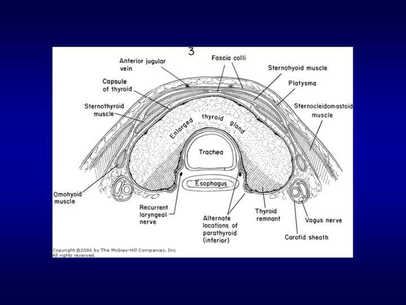 Diapositiva 13 de Tiroidectomía