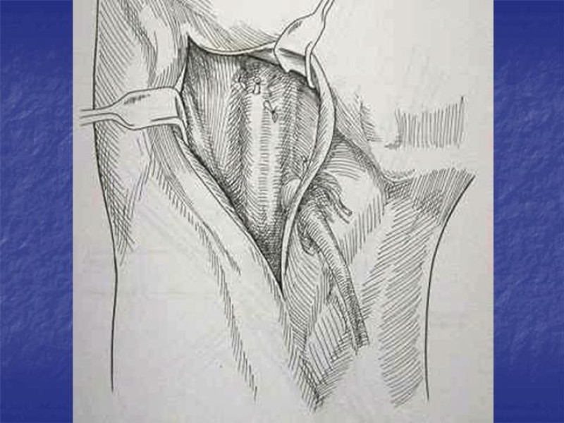 Diapositiva 91 de Abordaje Quirúrgico Vasculares