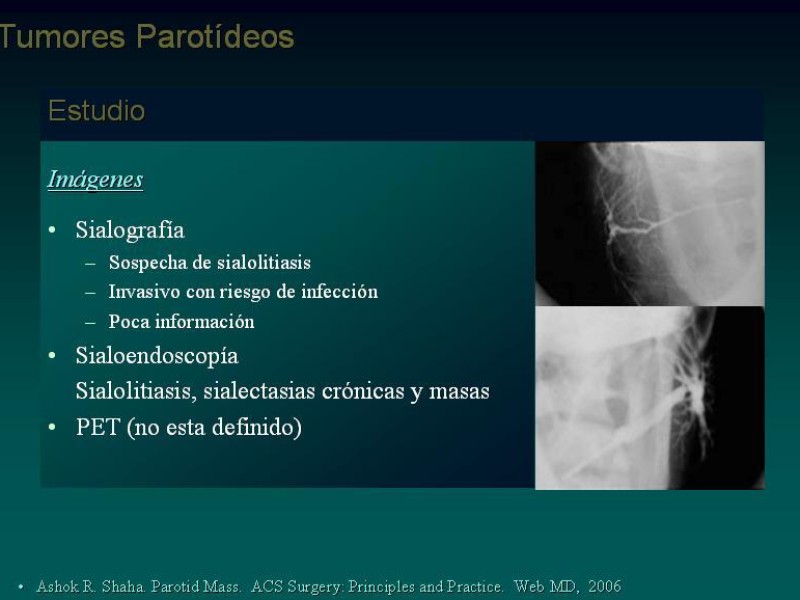 Diapositiva 17 de Masas Parotídeas