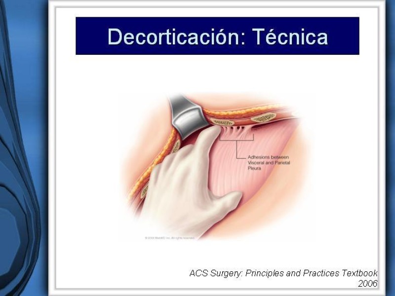 Diapositiva 36 de Empiema Pleural