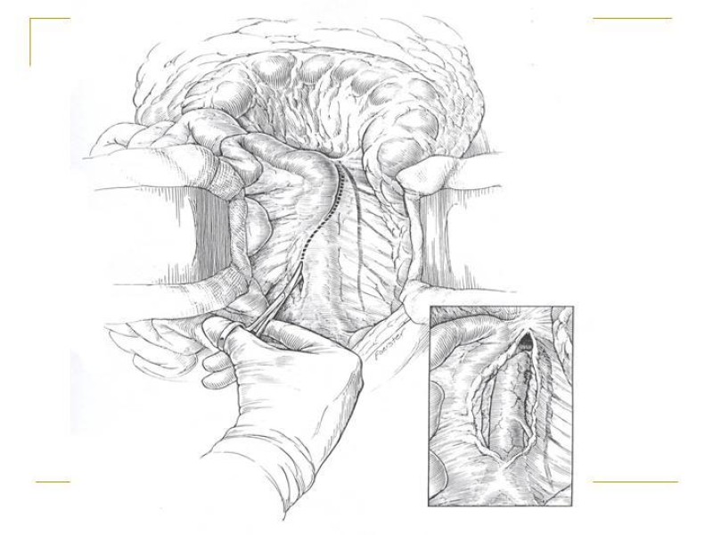 Diapositiva 20 de Accesos vasculares Abdominales