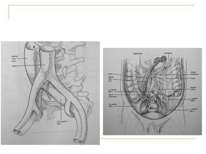 Diapositiva 47 de Accesos vasculares Abdominales