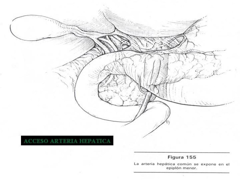 Diapositiva 80 de Accesos vasculares Abdominales