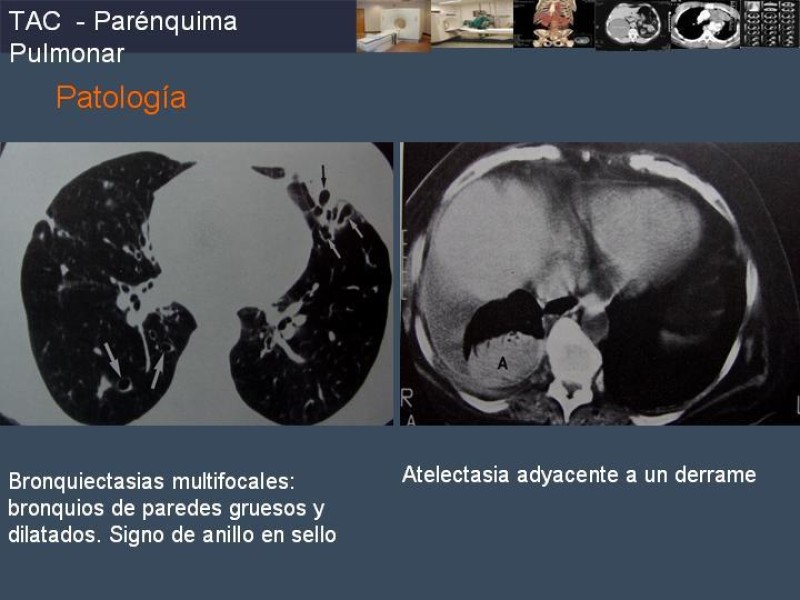Diapositiva 62 de Imaginología Toráxica TAC
