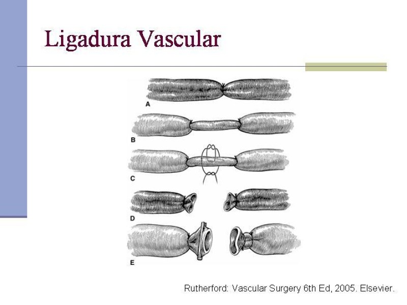 Diapositiva 11 de Reparación y Anastomosis Vasculares