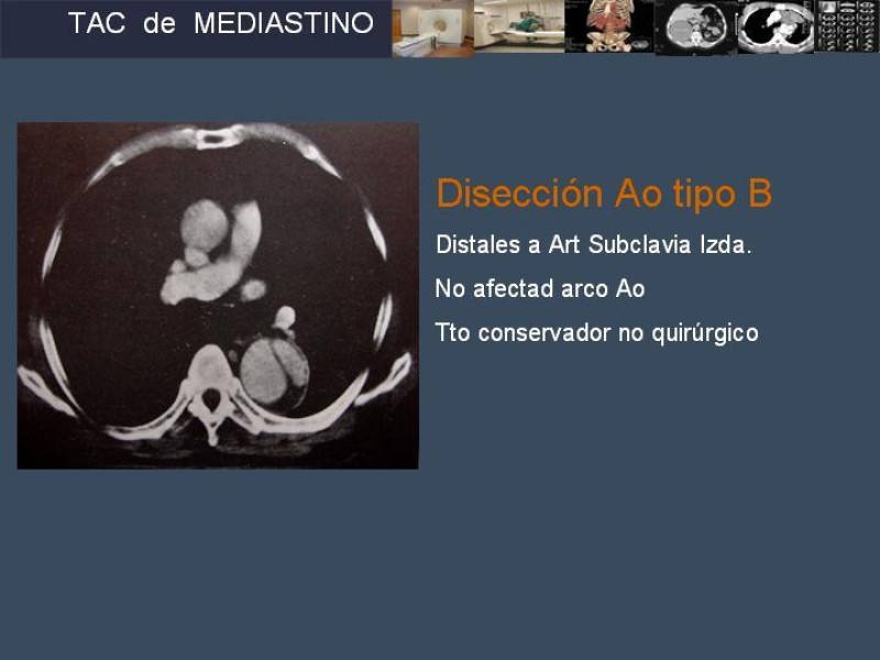 Diapositiva 28 de Imaginología Toráxica TAC