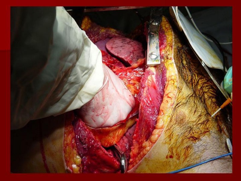 Diapositiva 19 de Toracotomía de Urgencia