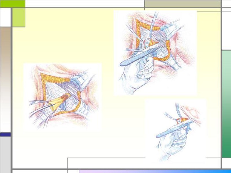 Diapositiva 14 de Tratamiento de la Hernia Femoral
