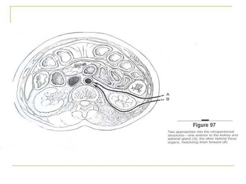 Diapositiva 27 de Accesos vasculares Abdominales