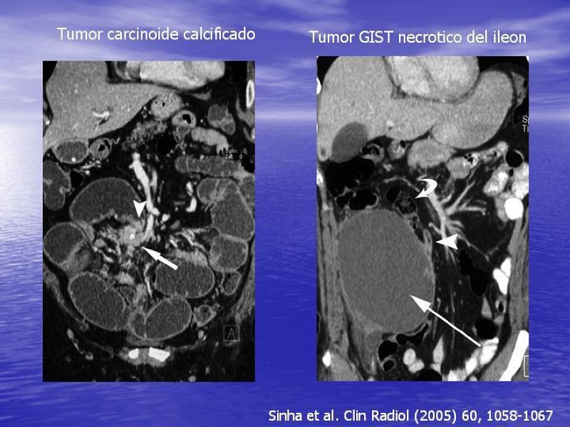 Diapositiva 20 de Obstrucción Intestinal: Estudio Diagnostico y Manejo inicial