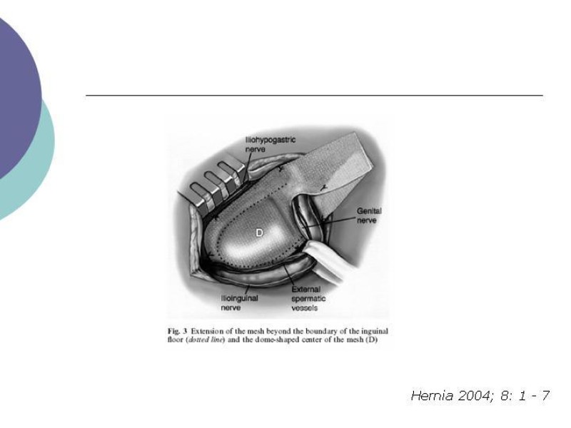 Diapositiva 14 de Hernia Inguinal: Técnica de Lichtenstein