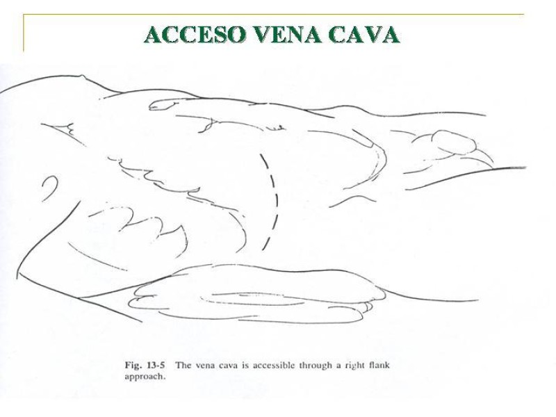 Diapositiva 93 de Accesos vasculares Abdominales
