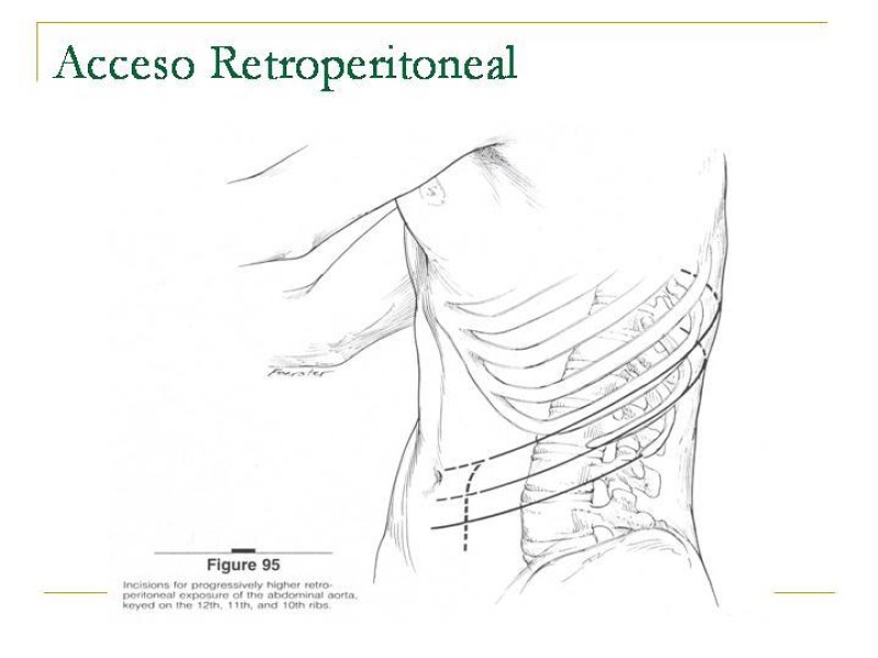 Diapositiva 38 de Accesos vasculares Abdominales