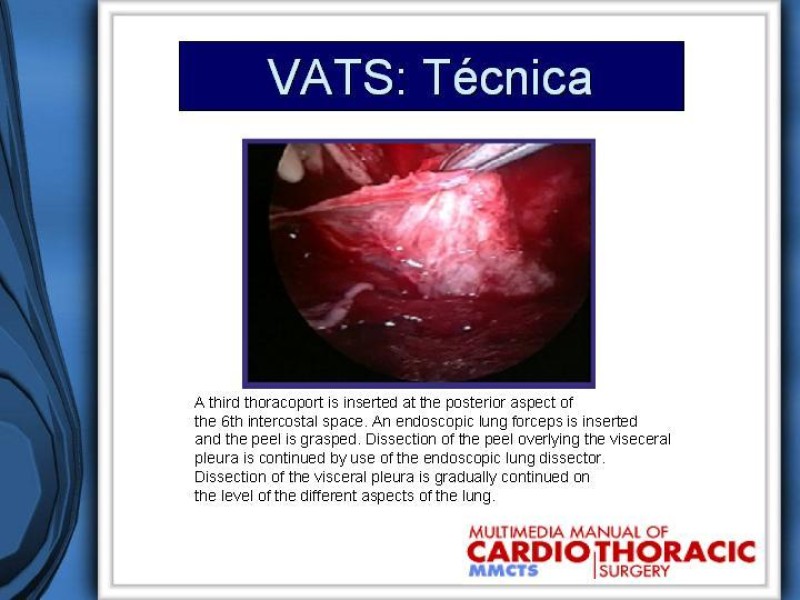 Diapositiva 31 de Empiema Pleural