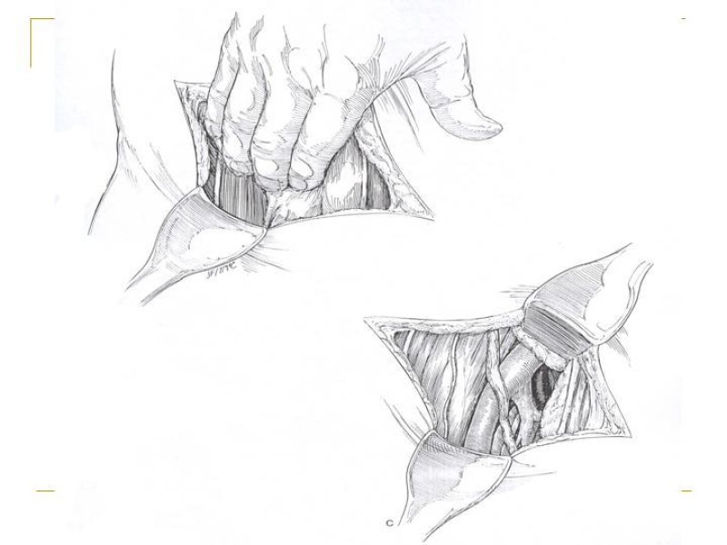 Diapositiva 54 de Accesos vasculares Abdominales