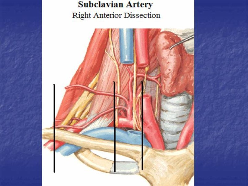 Diapositiva 41 de Abordaje Quirúrgico Vasculares