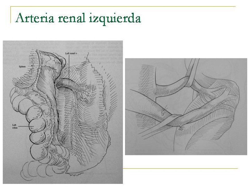 Diapositiva 88 de Accesos vasculares Abdominales