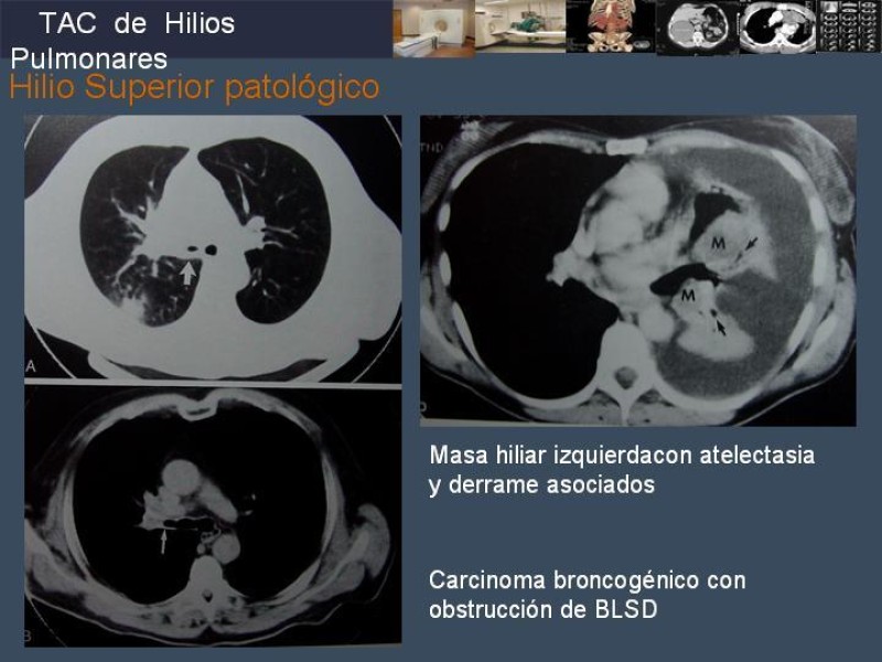 Diapositiva 50 de Imaginología Toráxica TAC