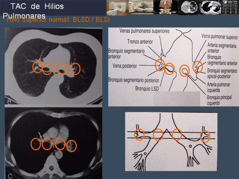 Diapositiva 47 de Imaginología Toráxica TAC