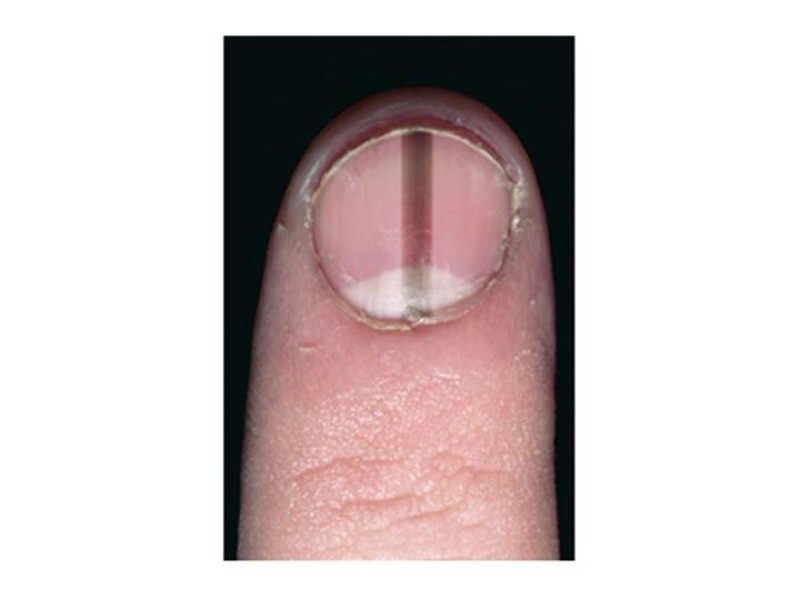 Diapositiva 21 de Melanoma