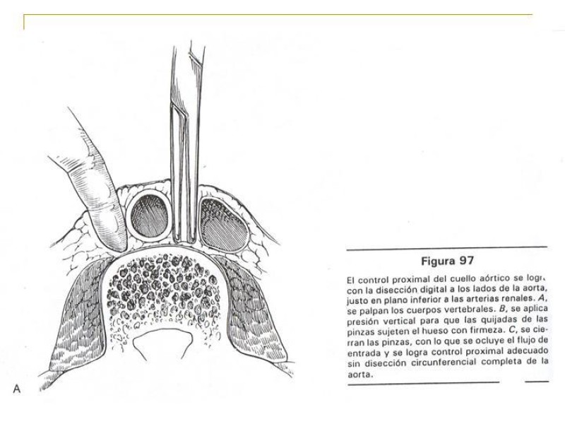 Diapositiva 15 de Accesos vasculares Abdominales