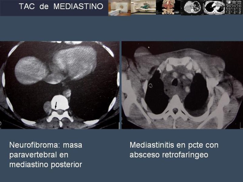 Diapositiva 41 de Imaginología Toráxica TAC