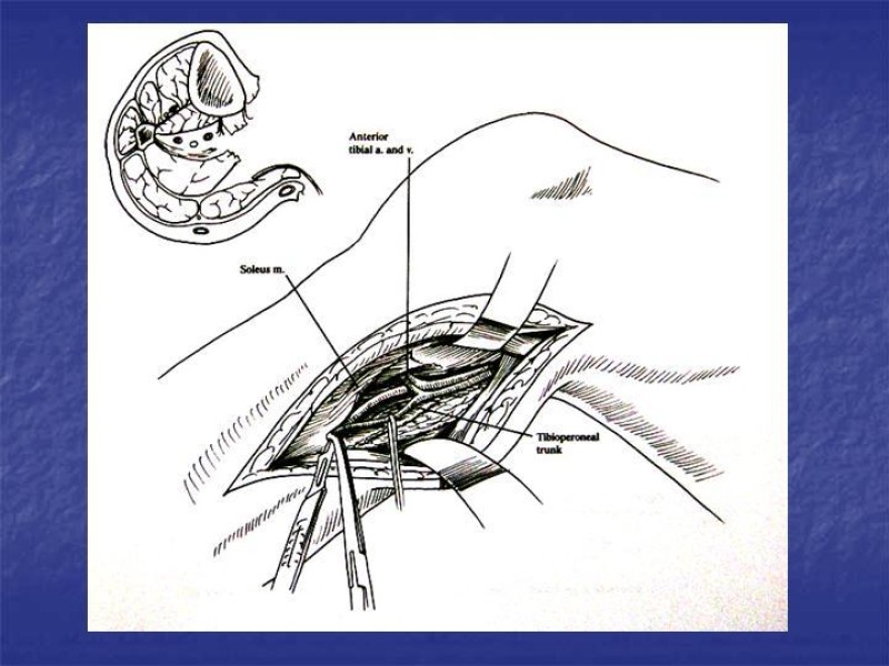 Diapositiva 114 de Abordaje Quirúrgico Vasculares