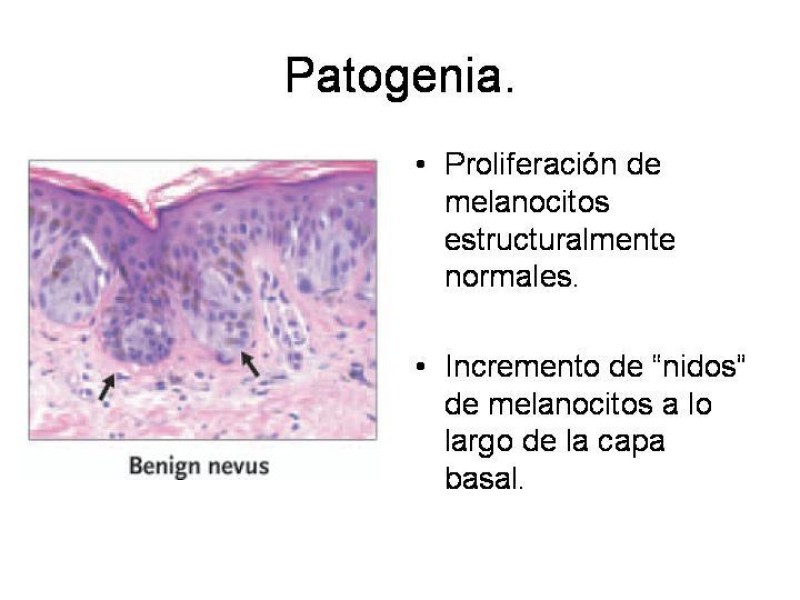 Diapositiva 9 de Melanoma