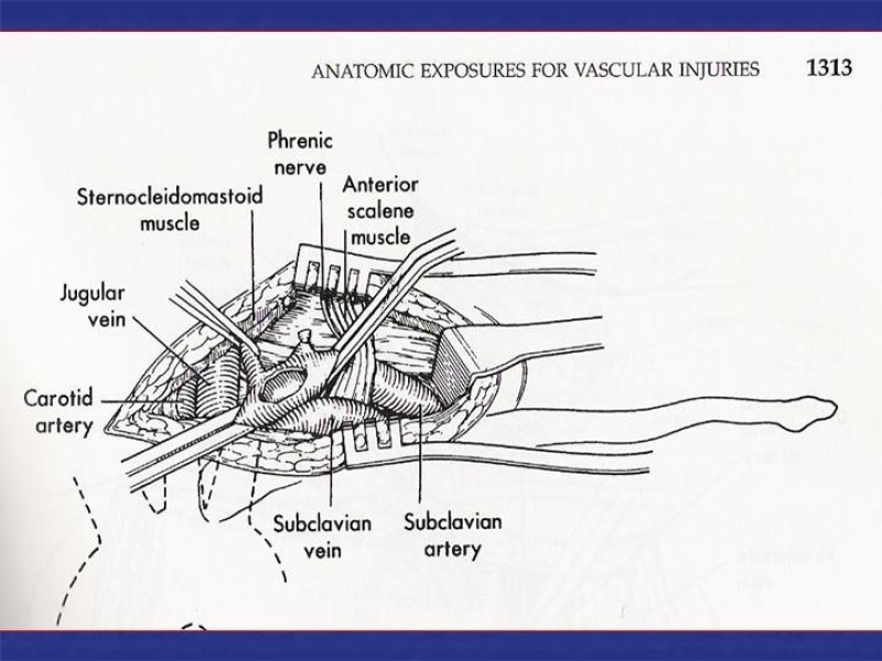 Diapositiva 46 de Abordaje Quirúrgico Vasculares