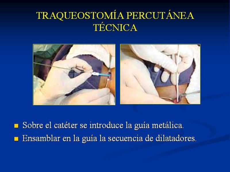 Diapositiva 26 de Traqueostomía Final
