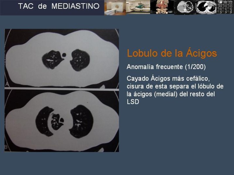 Diapositiva 29 de Imaginología Toráxica TAC