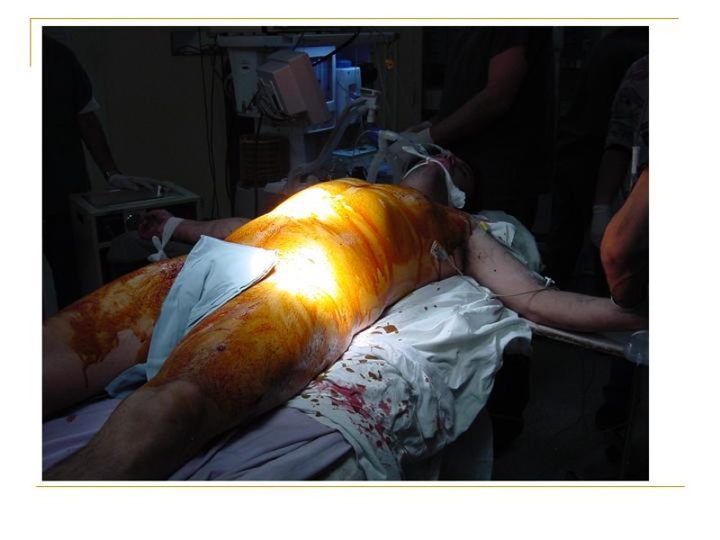 Diapositiva 10 de Accesos vasculares Abdominales