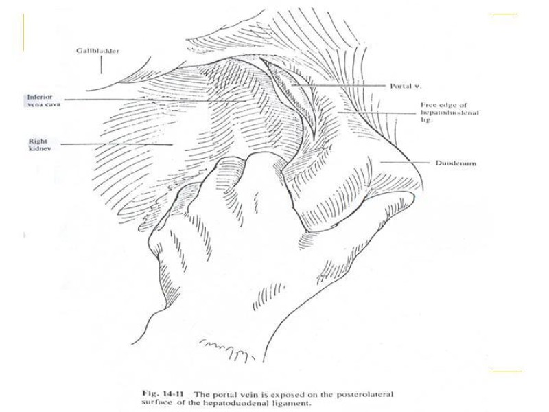Diapositiva 97 de Accesos vasculares Abdominales