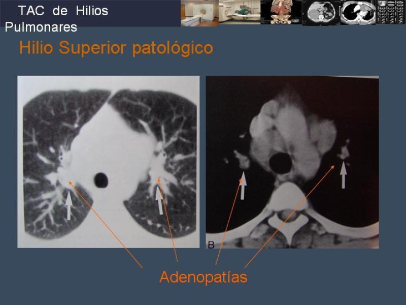 Diapositiva 46 de Imaginología Toráxica TAC