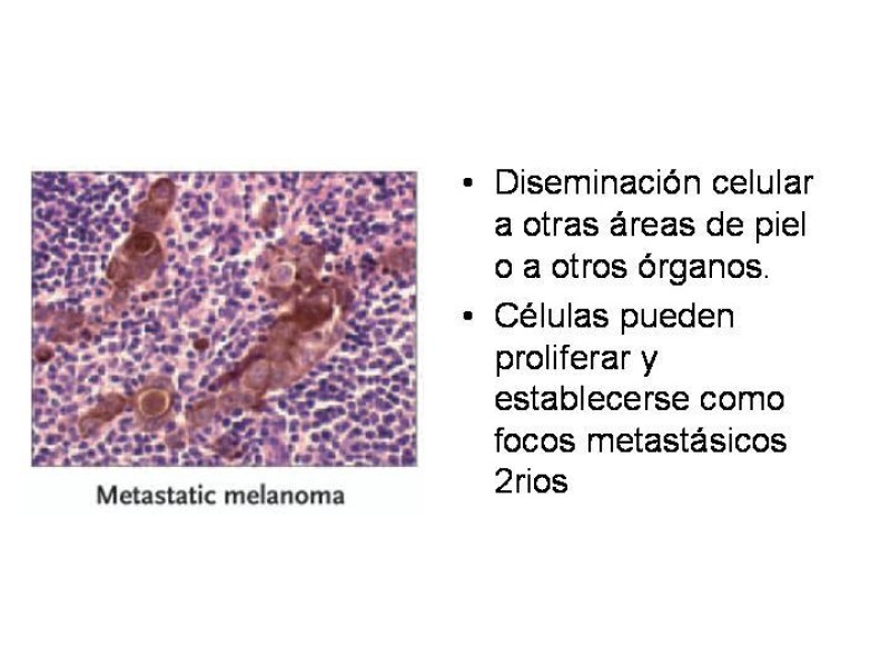 Diapositiva 13 de Melanoma