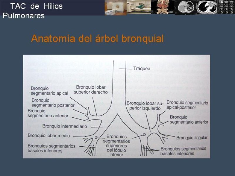 Diapositiva 44 de Imaginología Toráxica TAC