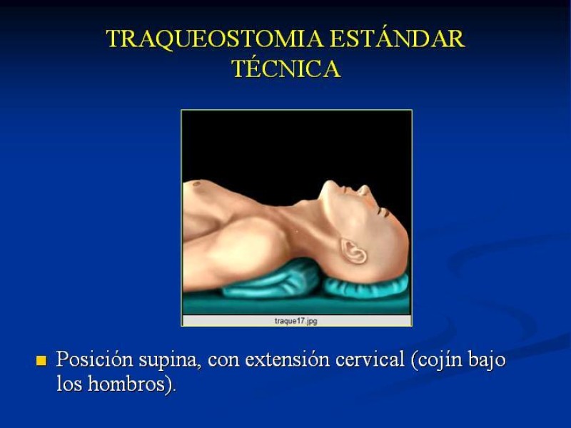 Diapositiva 9 de Traqueostomía Final