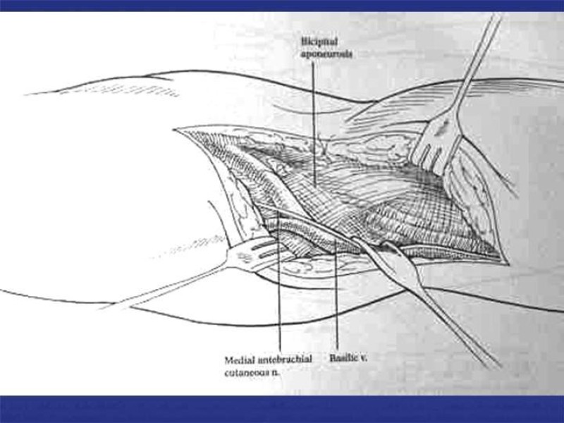 Diapositiva 74 de Abordaje Quirúrgico Vasculares