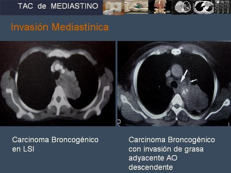 Diapositiva 36 de Imaginología Toráxica TAC