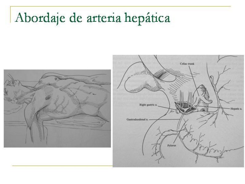 Diapositiva 79 de Accesos vasculares Abdominales