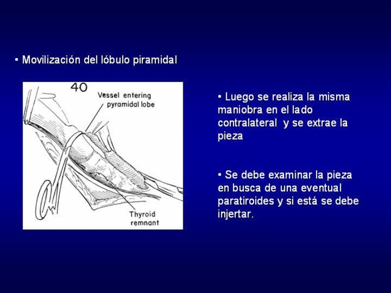 Diapositiva 20 de Tiroidectomía