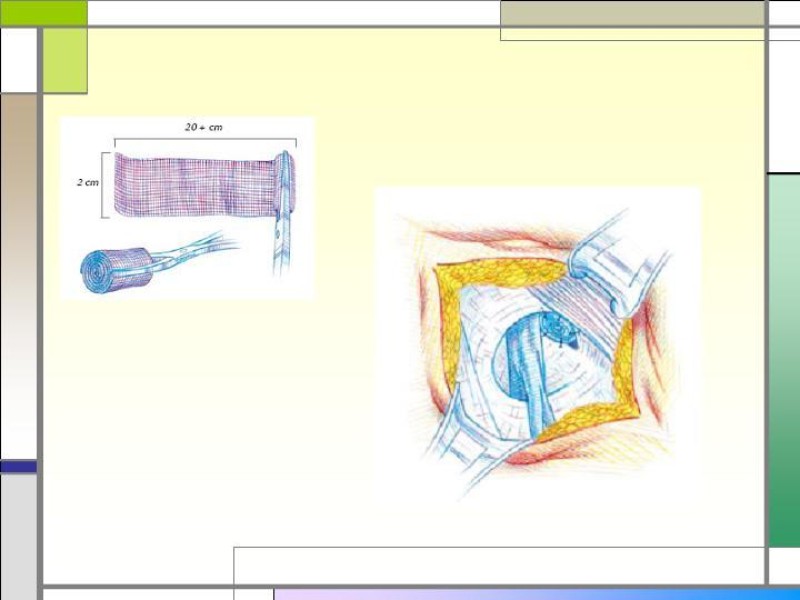 Diapositiva 18 de Tratamiento de la Hernia Femoral