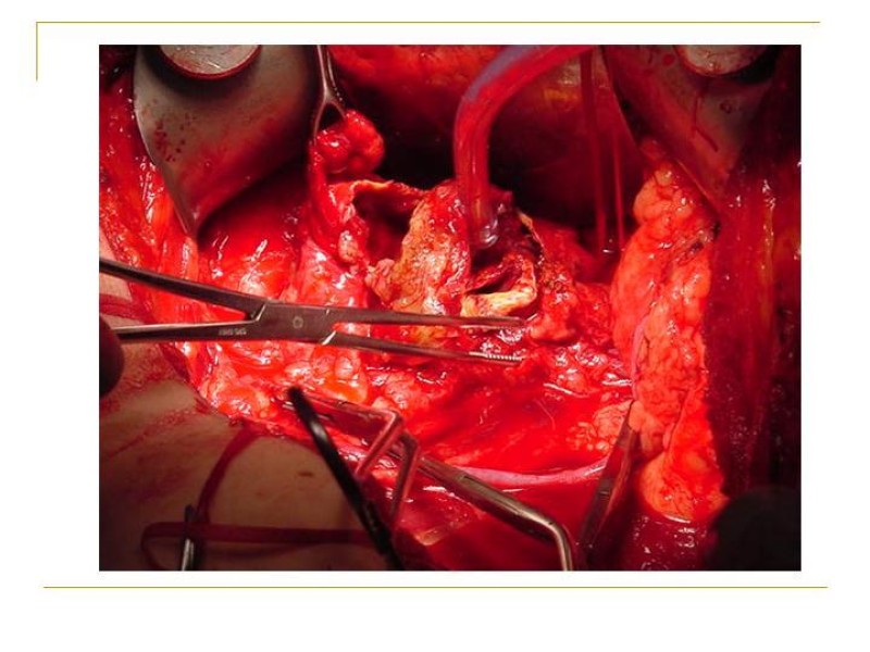 Diapositiva 43 de Accesos vasculares Abdominales