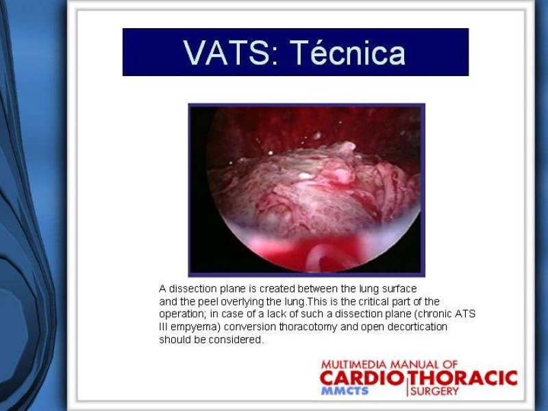 Diapositiva 30 de Empiema Pleural