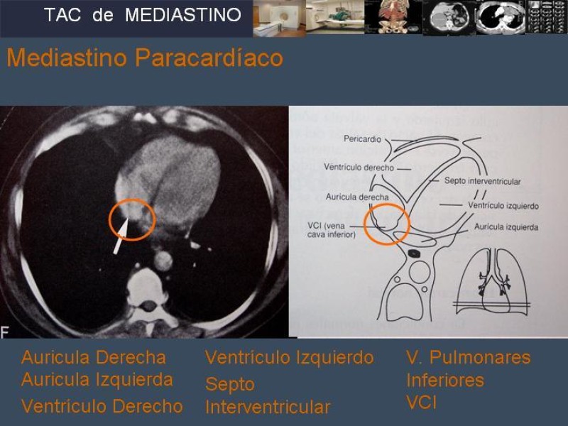 Diapositiva 21 de Imaginología Toráxica TAC