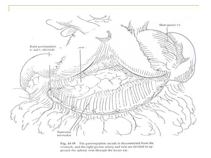 Diapositiva 99 de Accesos vasculares Abdominales