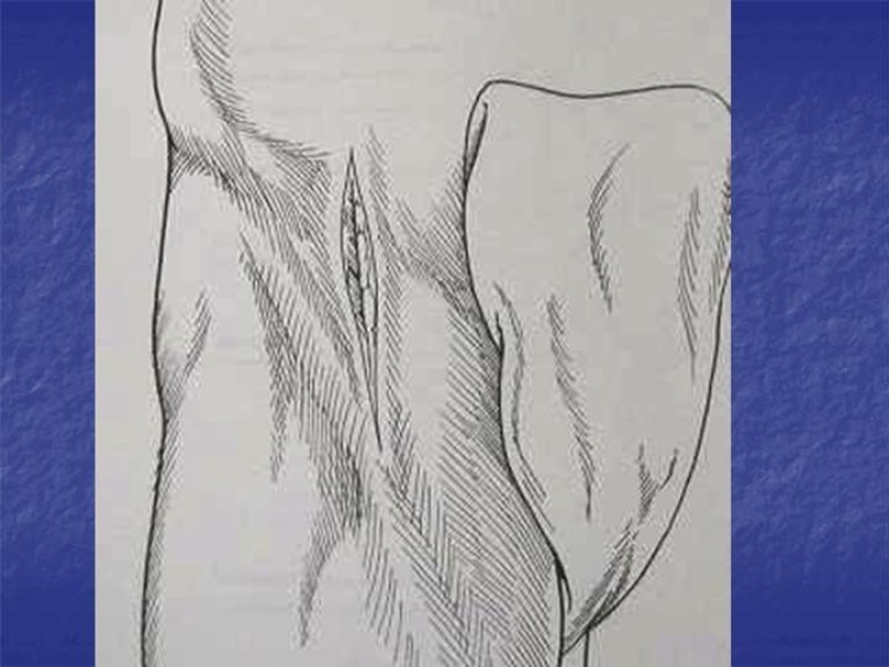 Diapositiva 90 de Abordaje Quirúrgico Vasculares