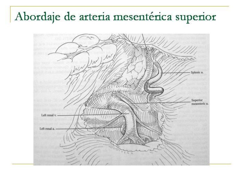 Diapositiva 74 de Accesos vasculares Abdominales
