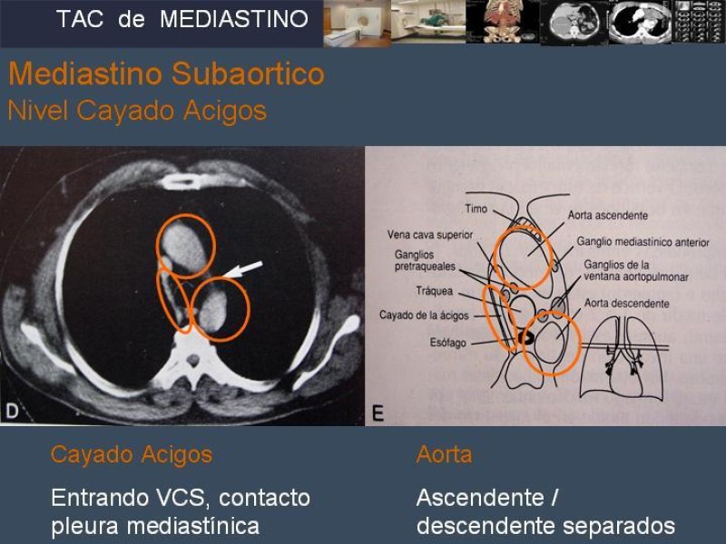 Diapositiva 15 de Imaginología Toráxica TAC