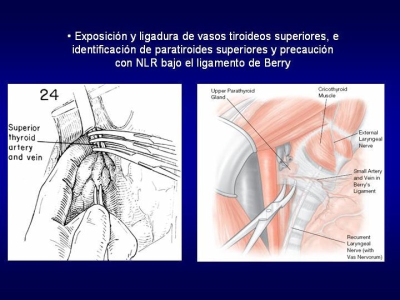 Diapositiva 18 de Tiroidectomía